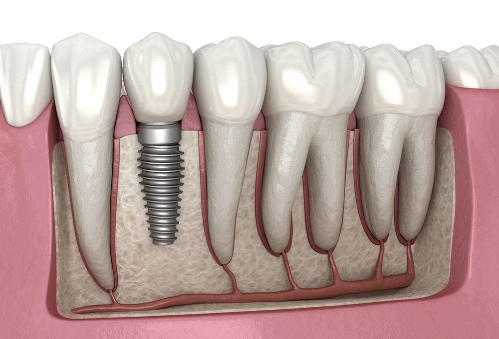 Dental Procedure